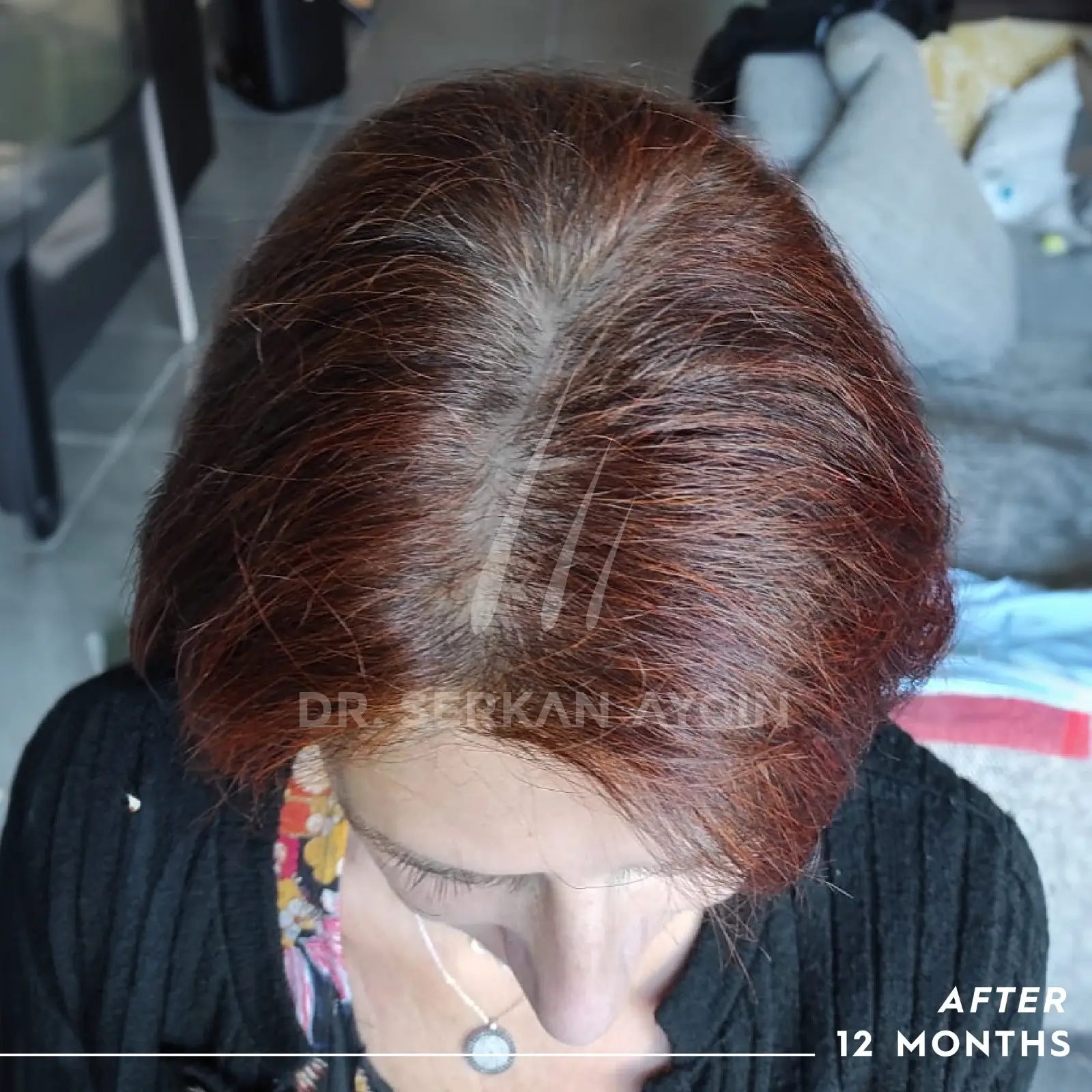 women hair transplant