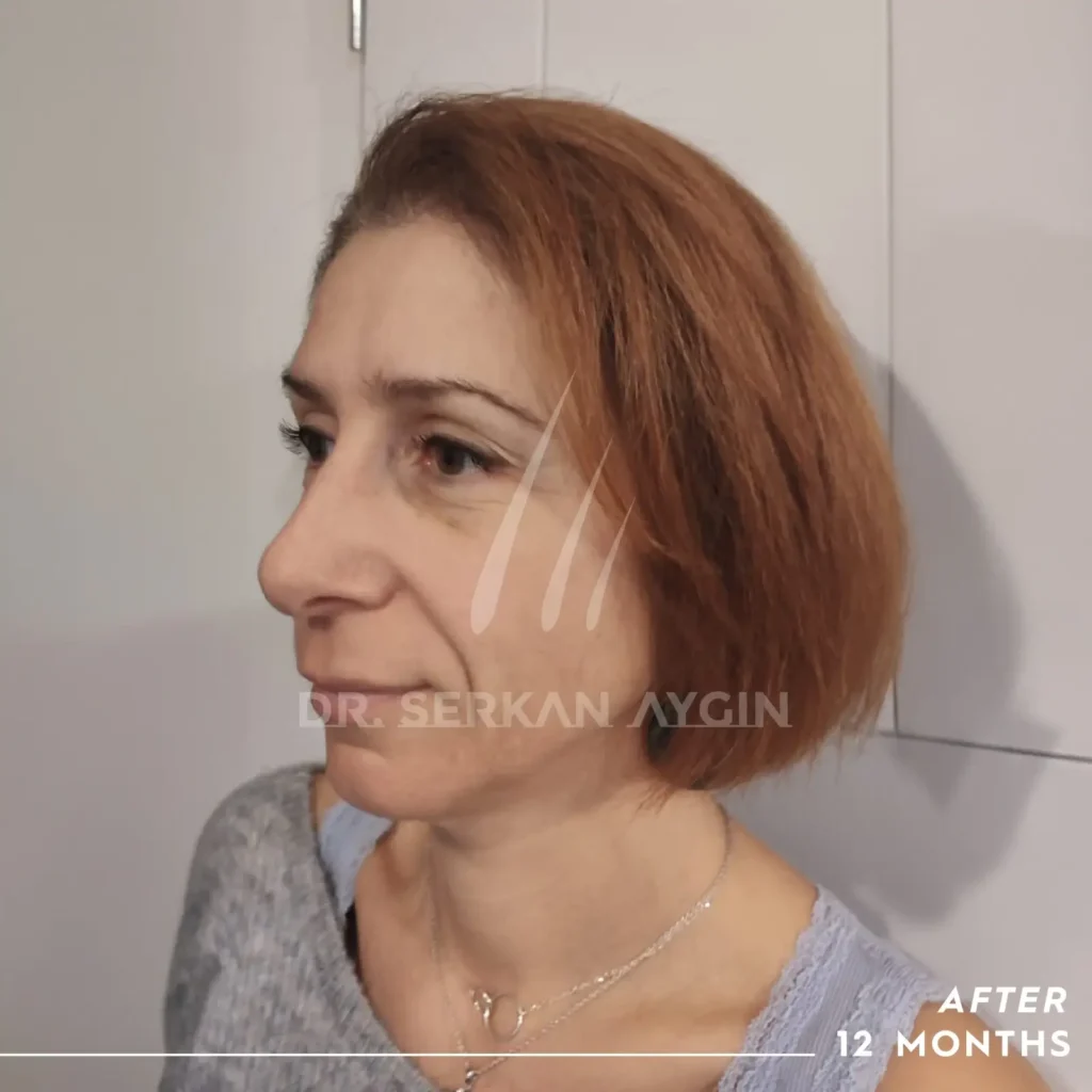 female hair transplant