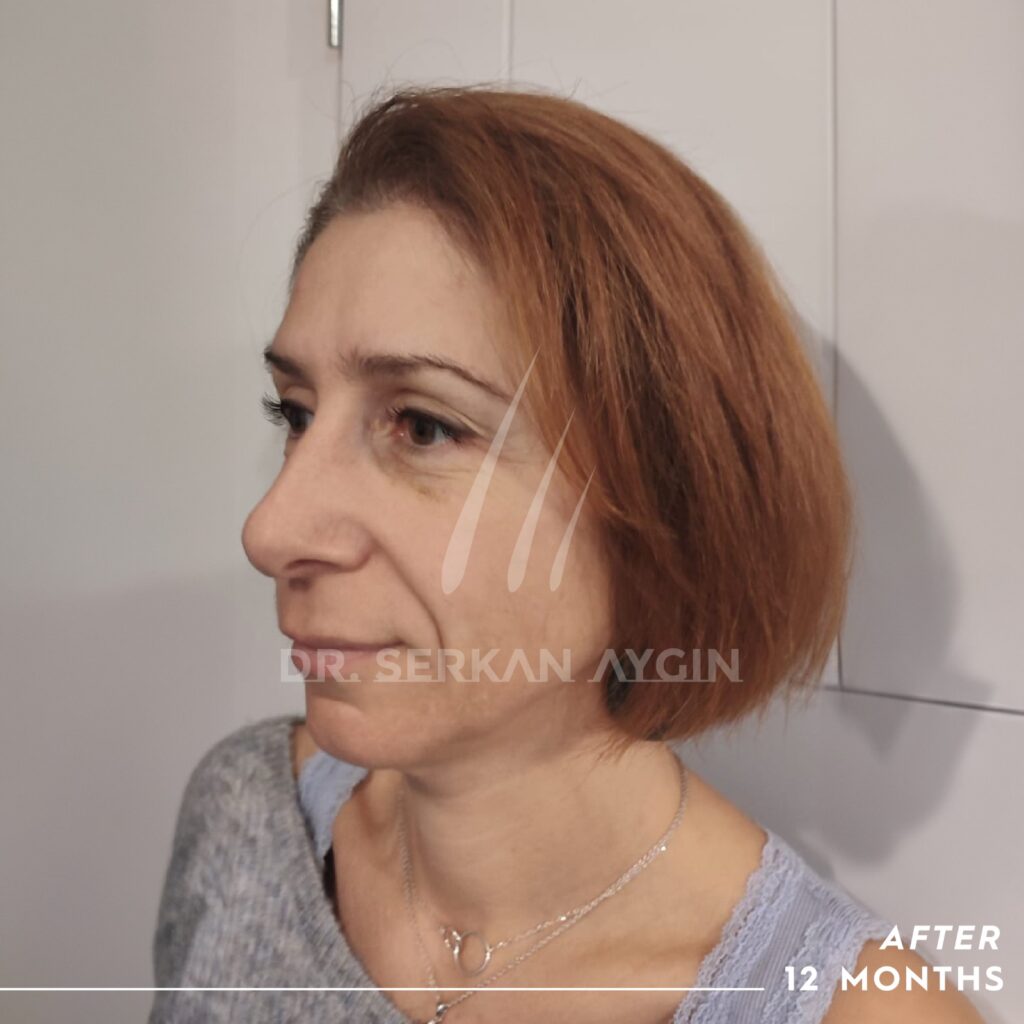 female hair transplant