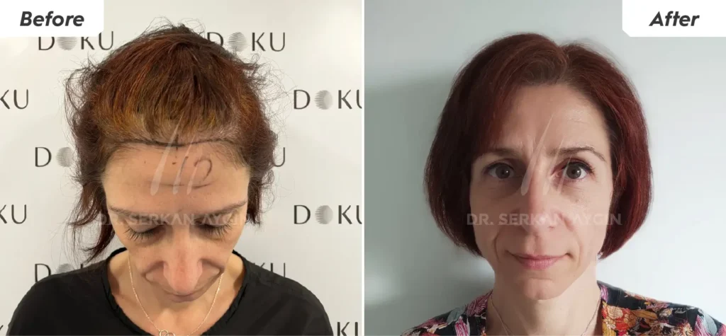 female hair transplant before and after