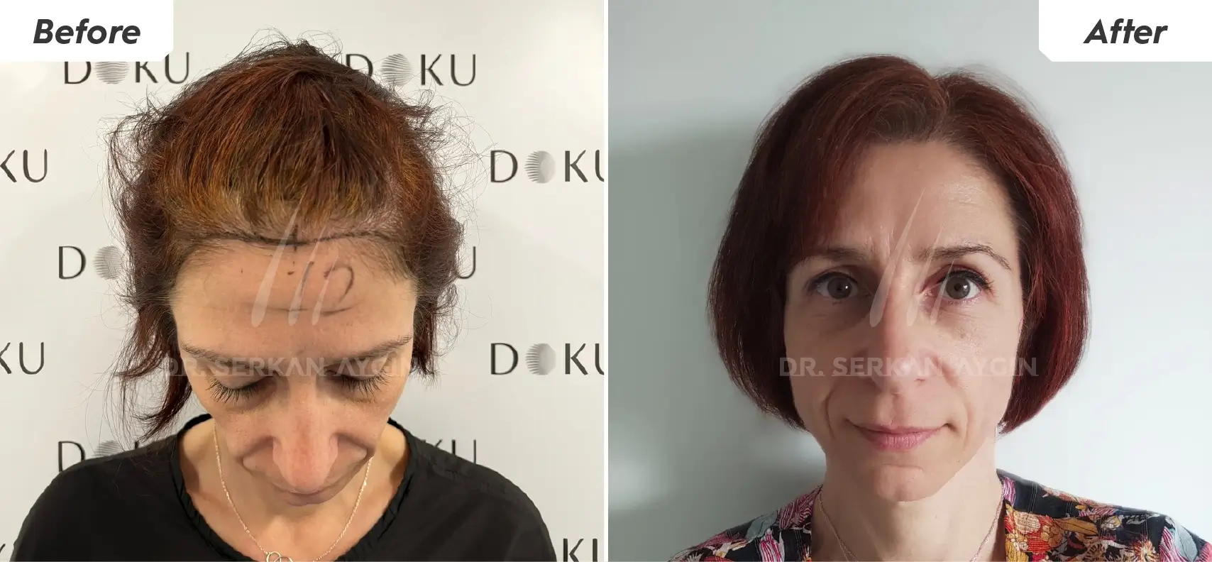female hair transplant before and after