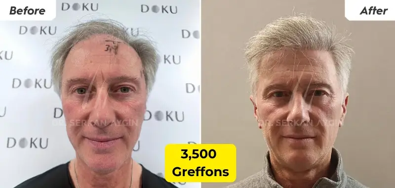 3 500 Greffes de Cheveux