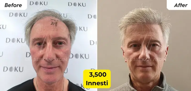 3500 Innesti - Trapianto di Capelli