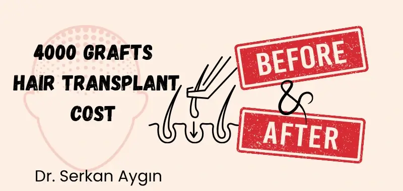 4000 graft cost and B&A