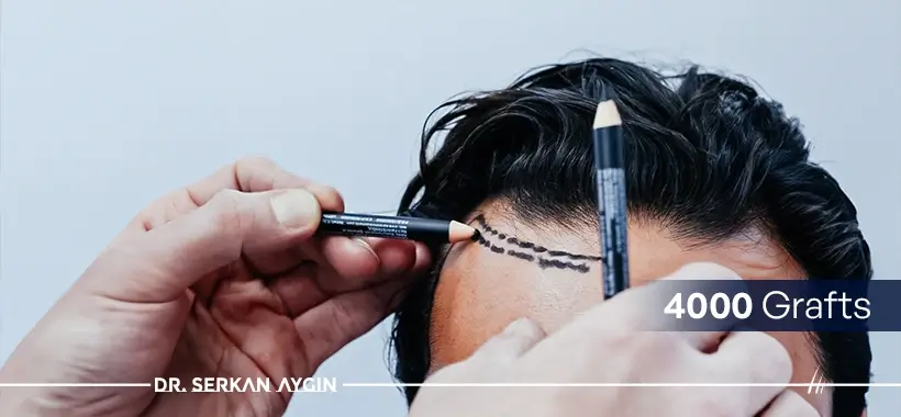 4000 grafts