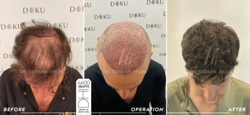 5000 Grafts Haartransplantation vorher nachher