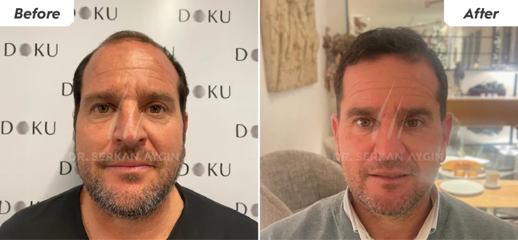 5000 innesti trapianti di capelli