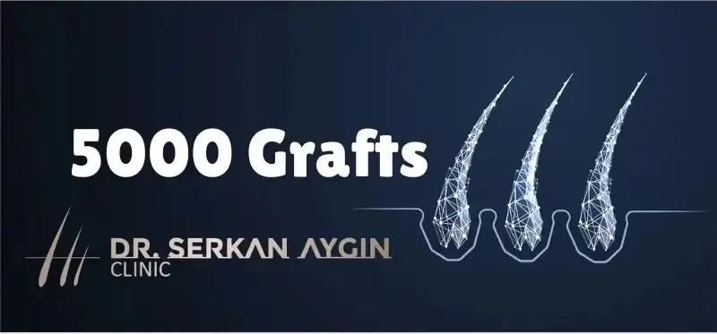 5000 grafts