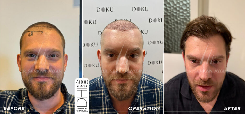 judd before and after 4000