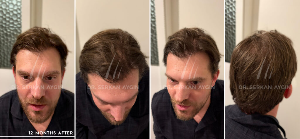 judd before and after 4000