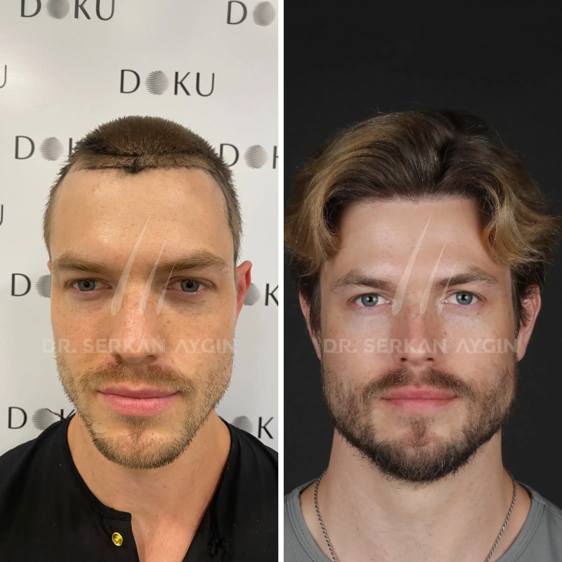 hair-transplant-turkey-before-after-drserkanaygin