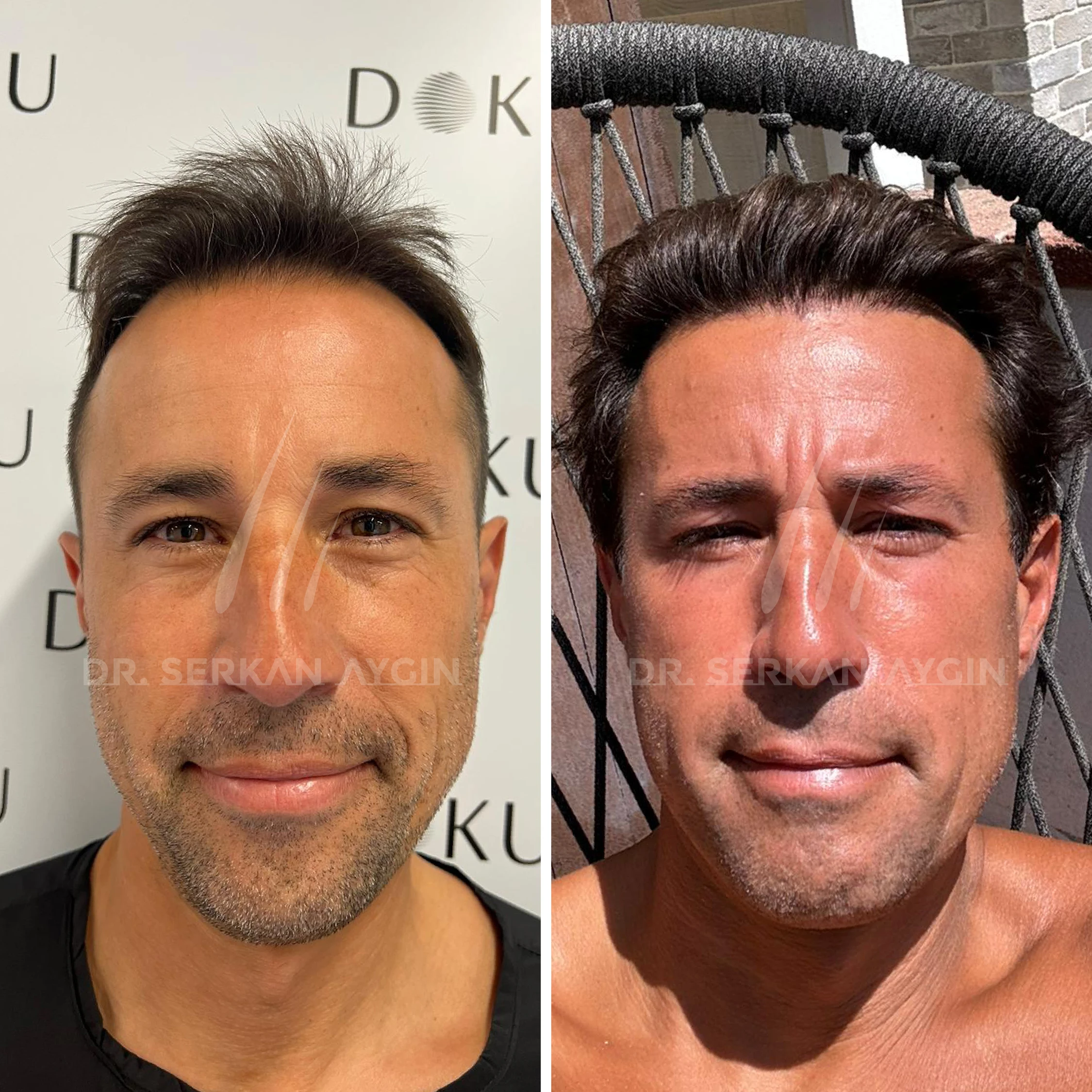 hair-transplant-turkey-before-after-drserkanaygin