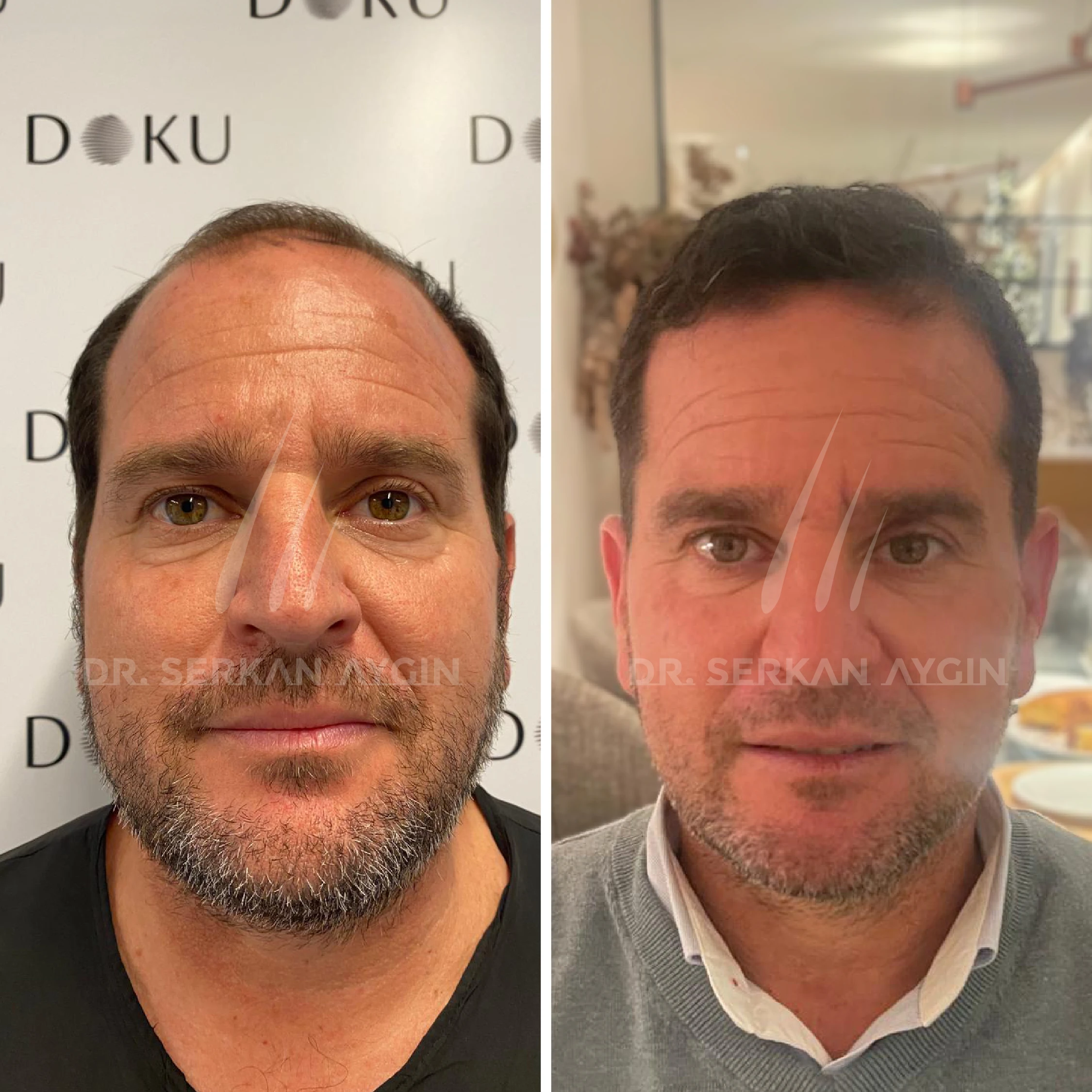 hair-transplant-turkey-before-after-drserkanayginclinic