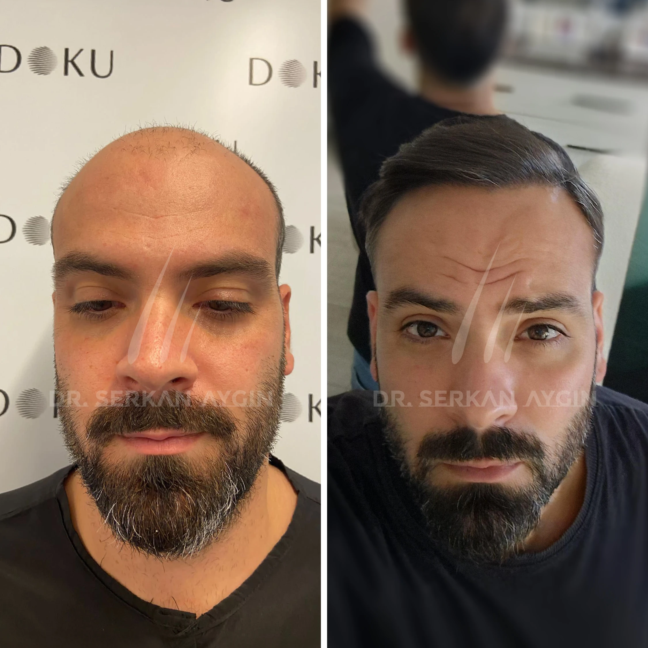 hair-transplant-turkey-before-after-drserkanayginclinic