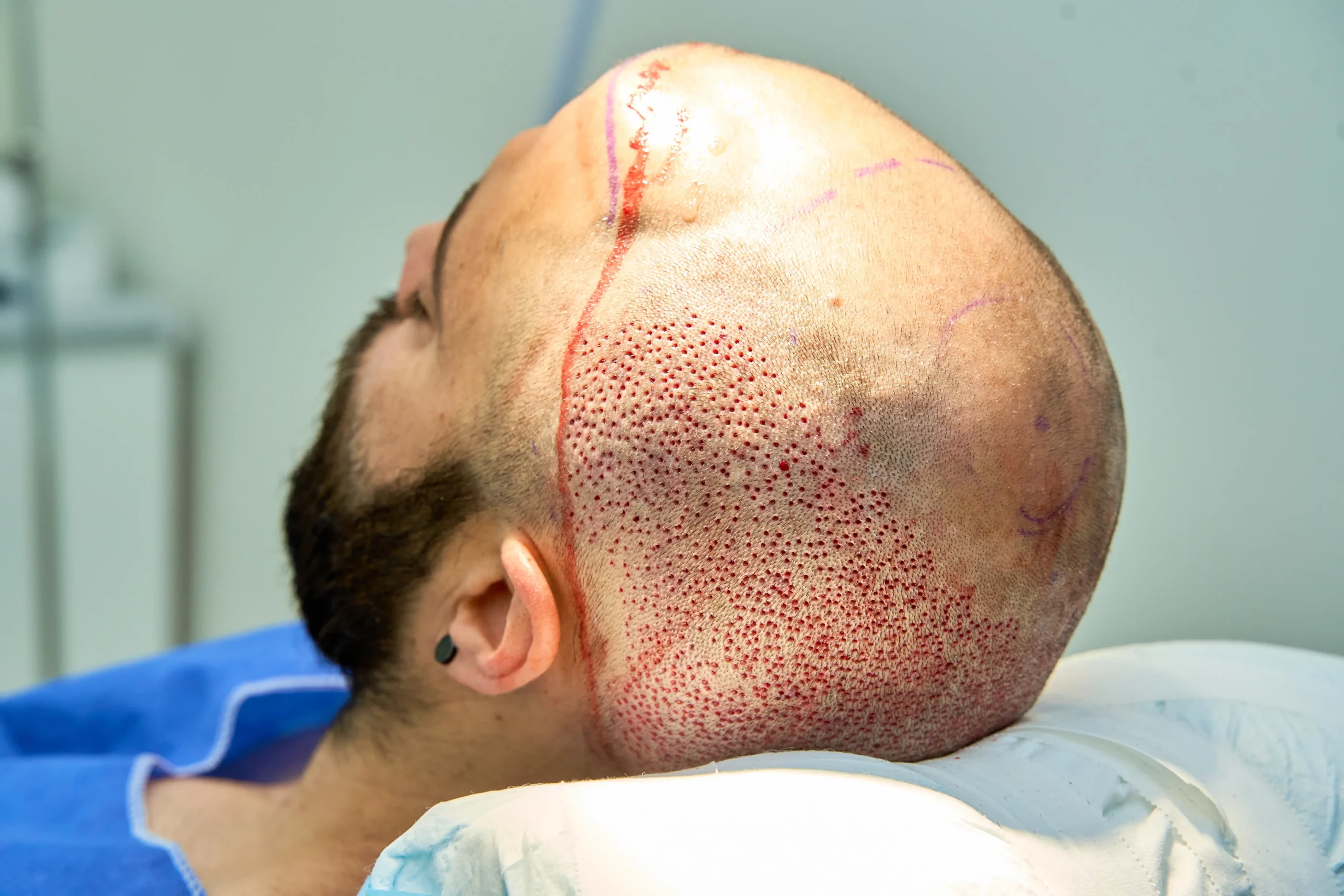 keloid scars hair transplant