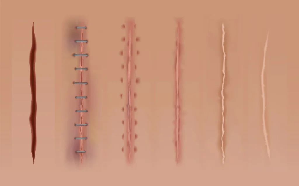 keloid scars hair transplant