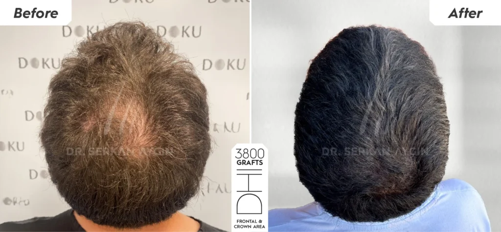 Dr. Serkan Aygın administering Magellan PRP hair treatment to support scalp regeneration and hair restoration.
