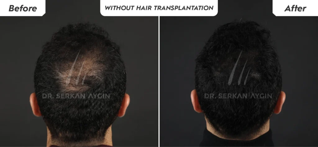 Dr. Serkan Aygın performing Magellan PRP hair treatment for improved hair restoration results