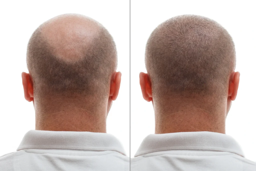 mexico hair transplant cost