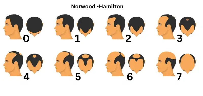 norwood hamilton scale 