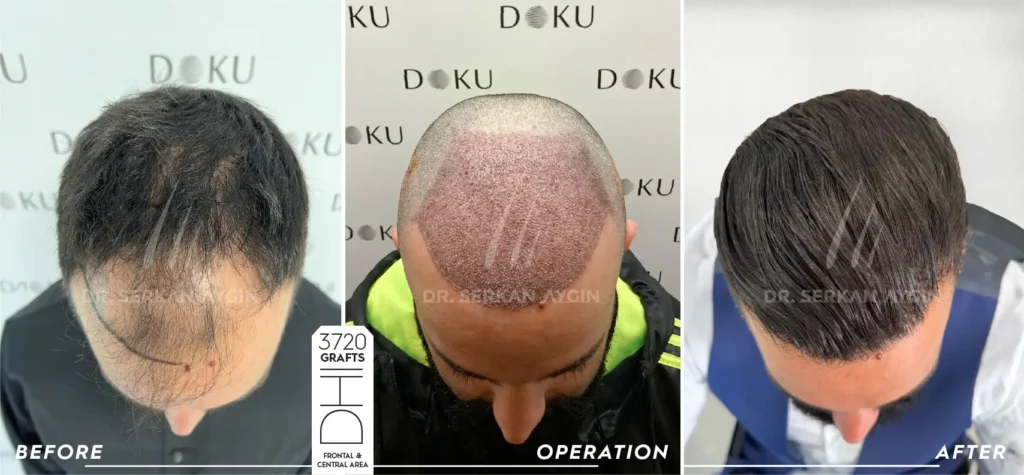 FABIO before and after