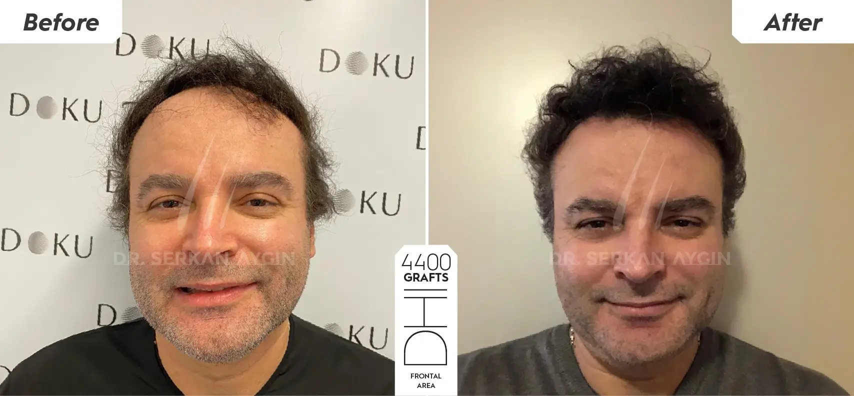 MARCO before and after 4400