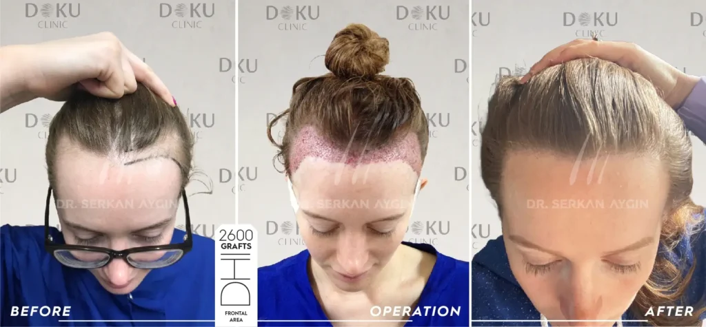 female hair transplant