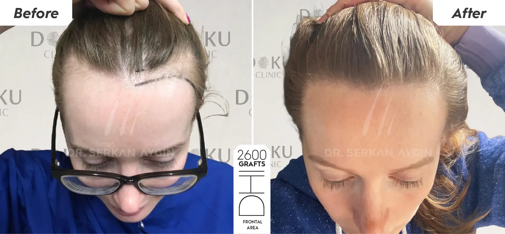 Female hair transplant