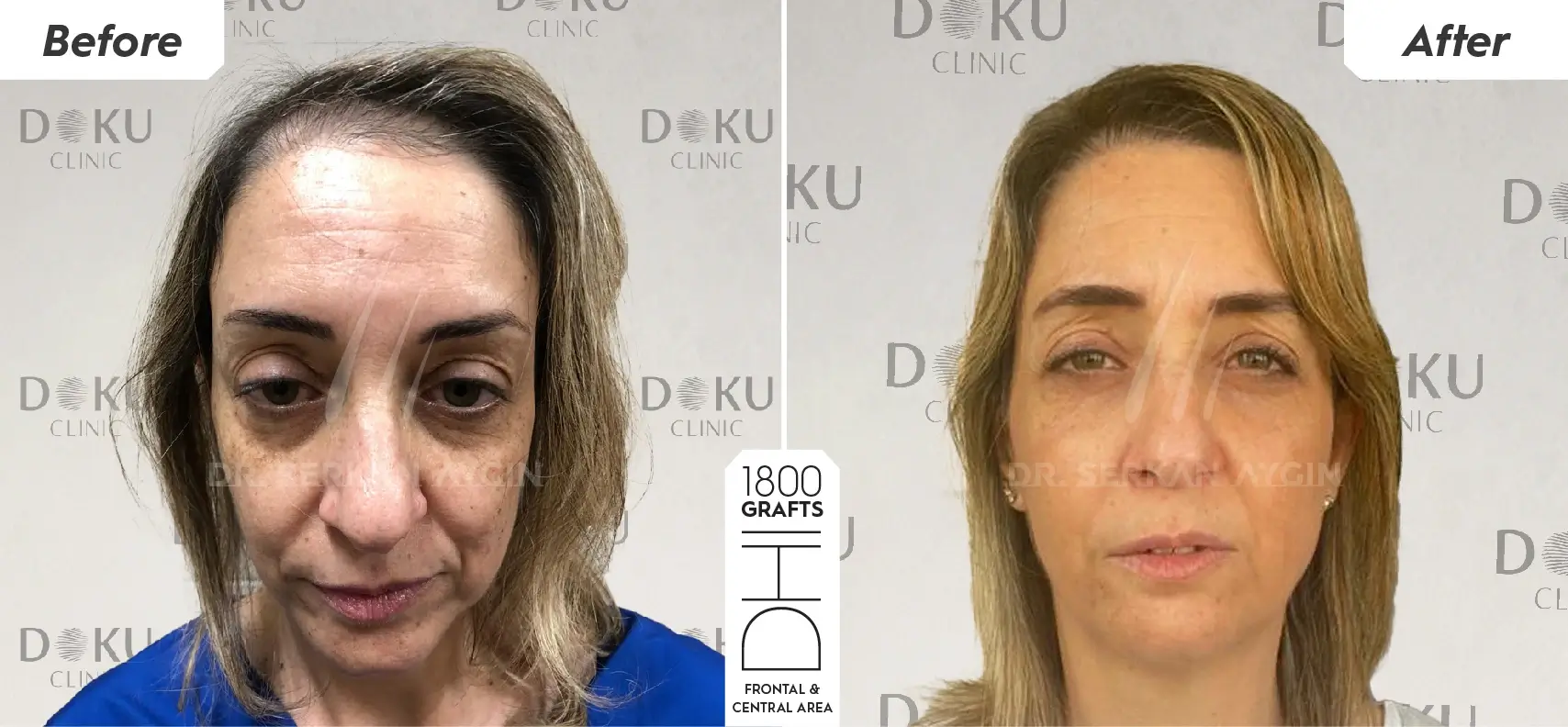 before and after 1800 female