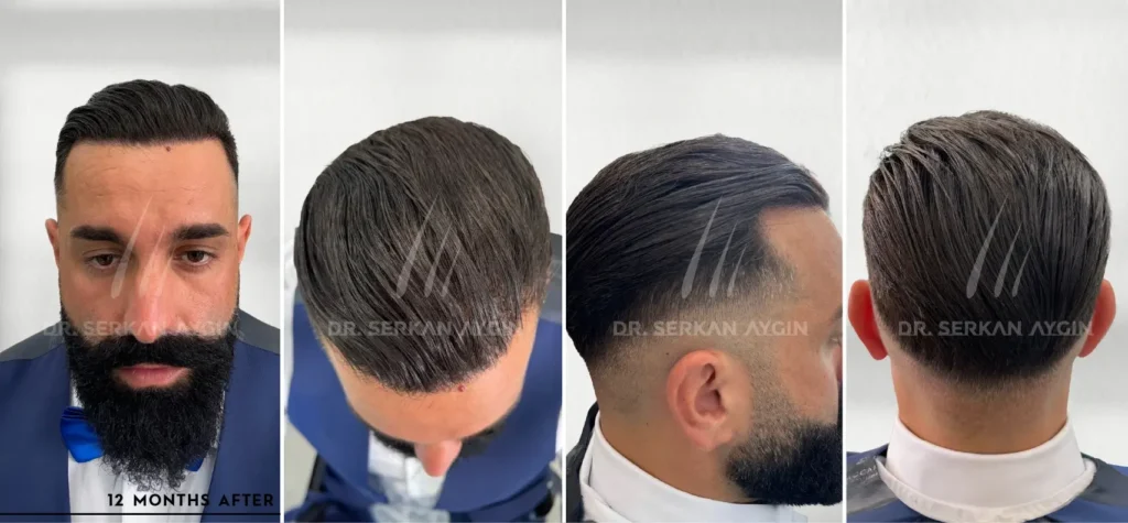 before and after 3720