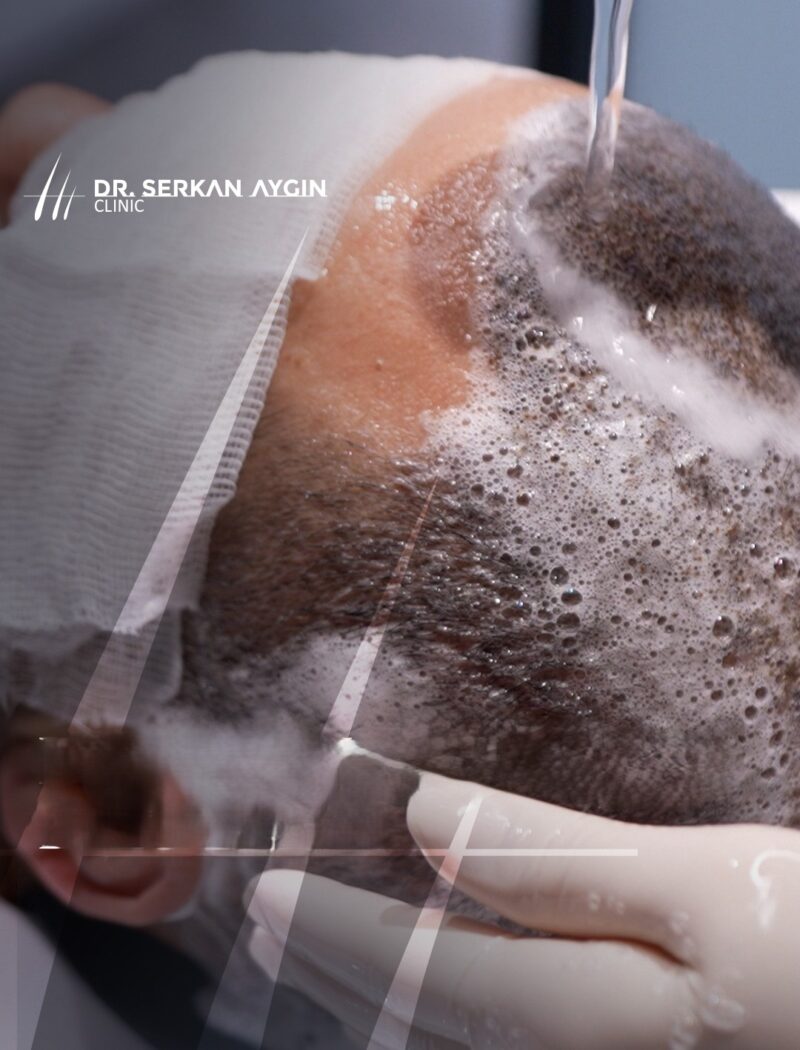 hair transplant wash-postop protocol