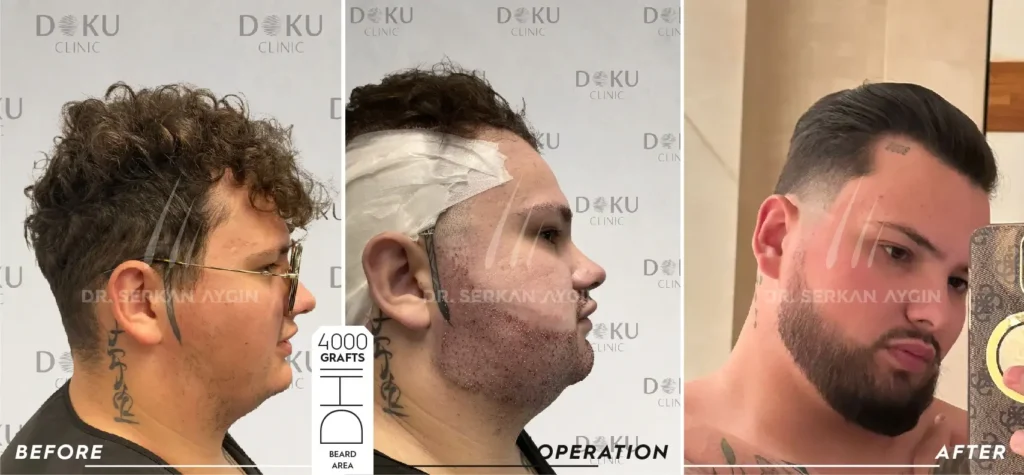 beard transplant
