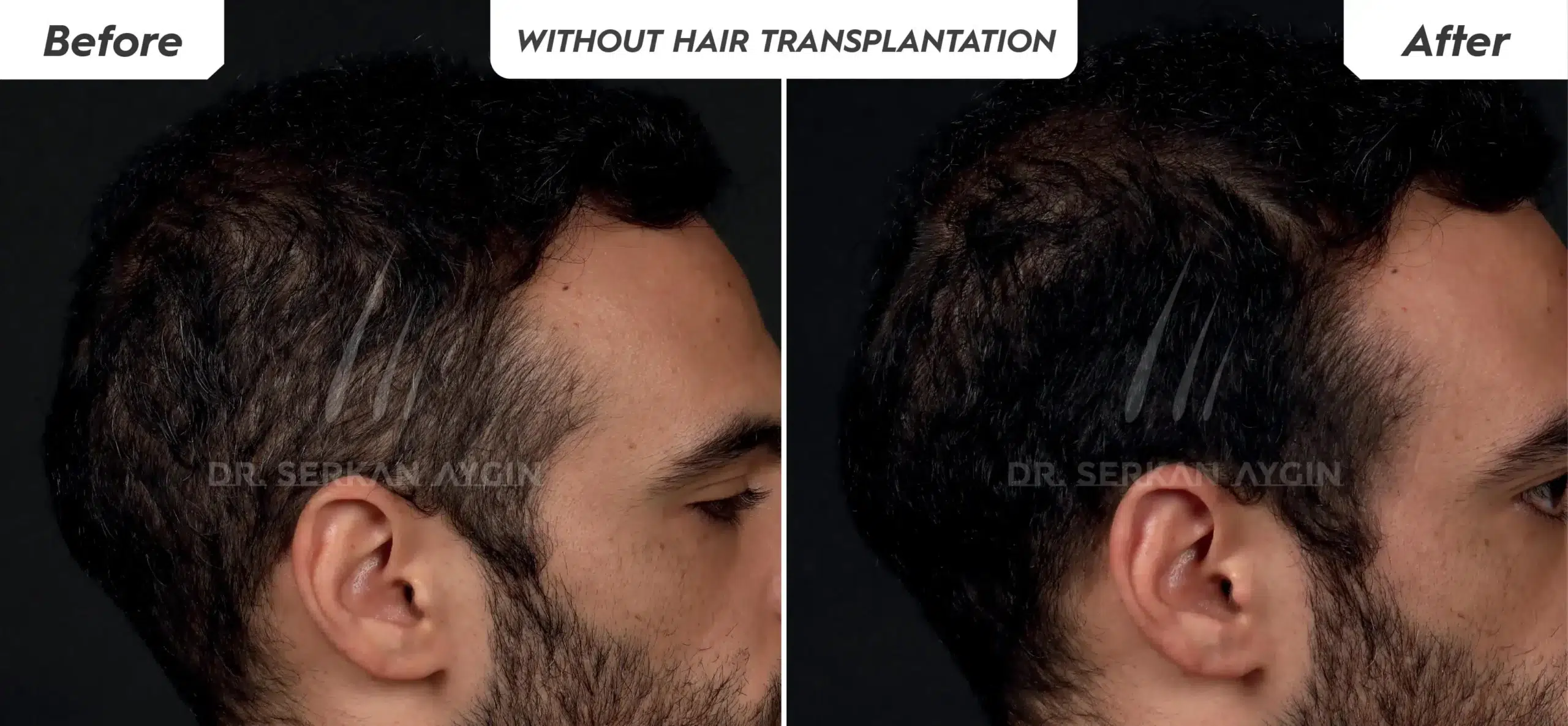 Exosome treatment for hair loss without hair transplantation
