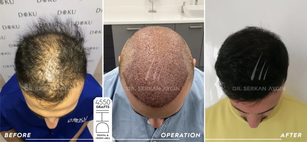 Ivan Before and After