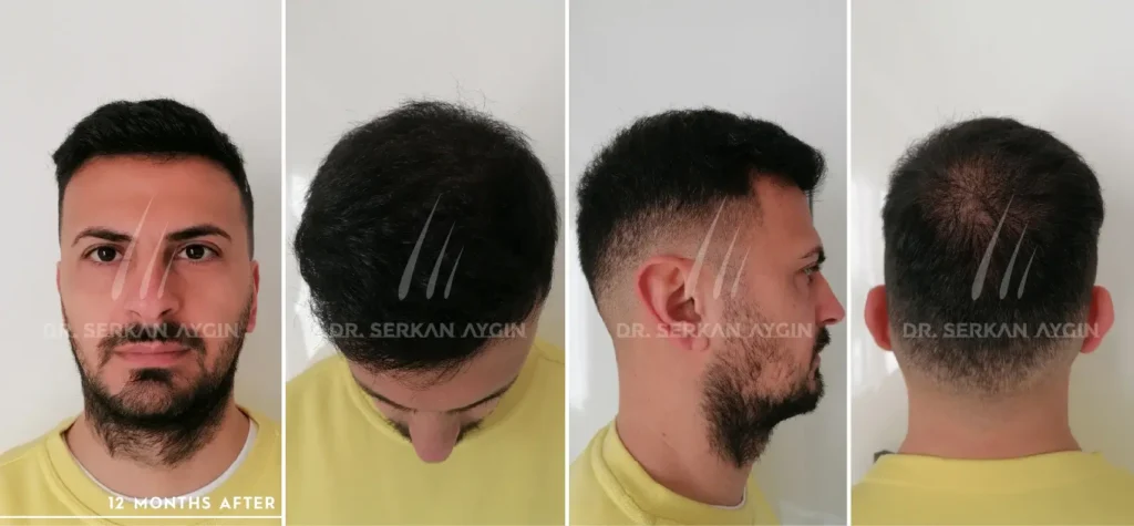 Ivan Before and After