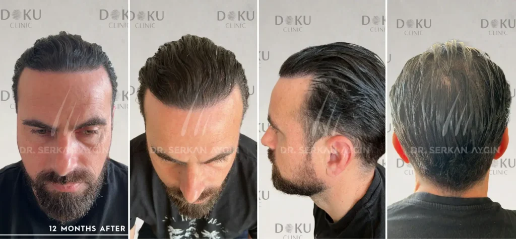 Before and after 3700