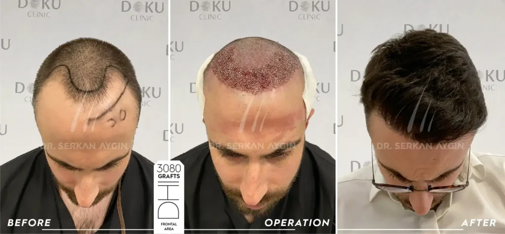 before and after remy