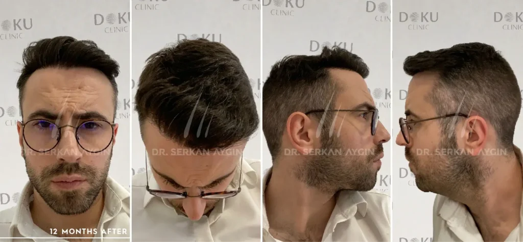 before ad after remy