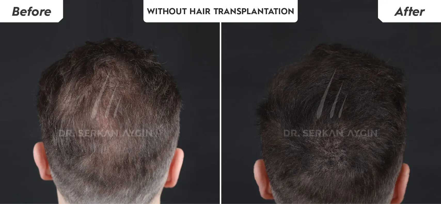 Alloblast fibroblast stem cell therapy at Dr. Serkan Aygın Clinic