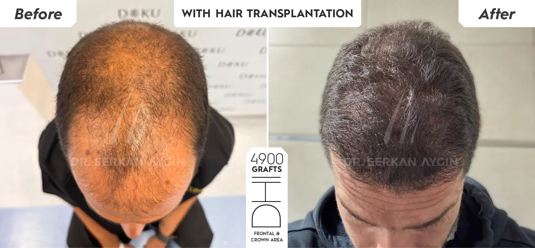 Alloblast fibroblast stem cell therapy procedure