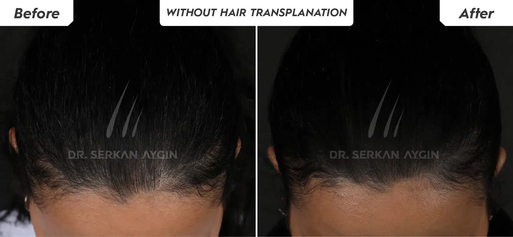 Autologous Exosome Treatment for Hair Loss in Turkey by Dr. Serkan Aygin