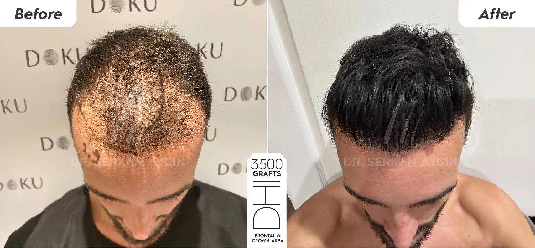 Autologous Exosome Treatment for Hair Loss in Turkey by Dr. Serkan Aygin