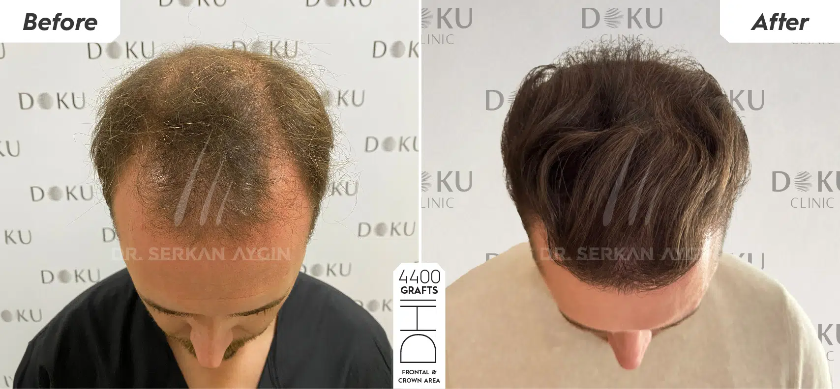 SVF stem cell treatment after hair transplant