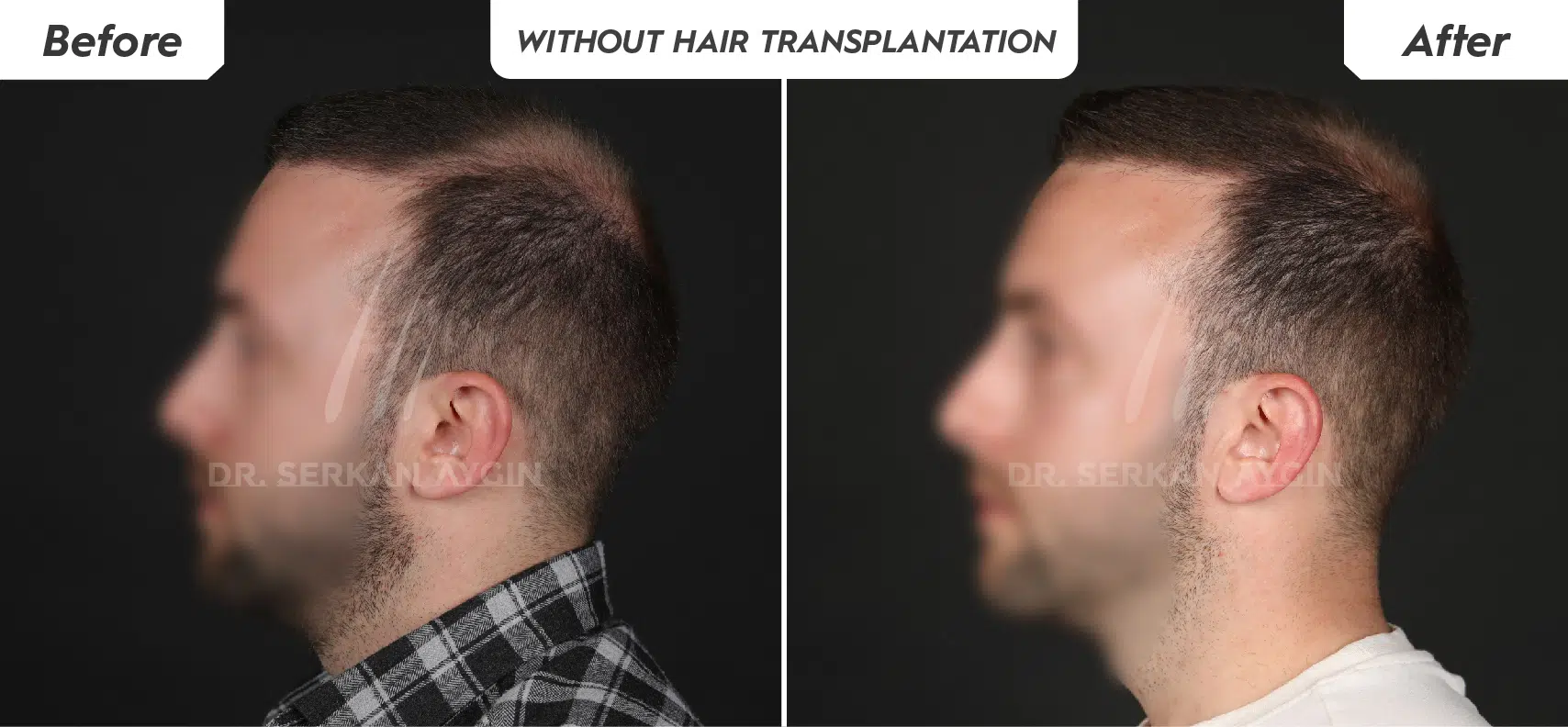 SVF stem cell support before hair transplant