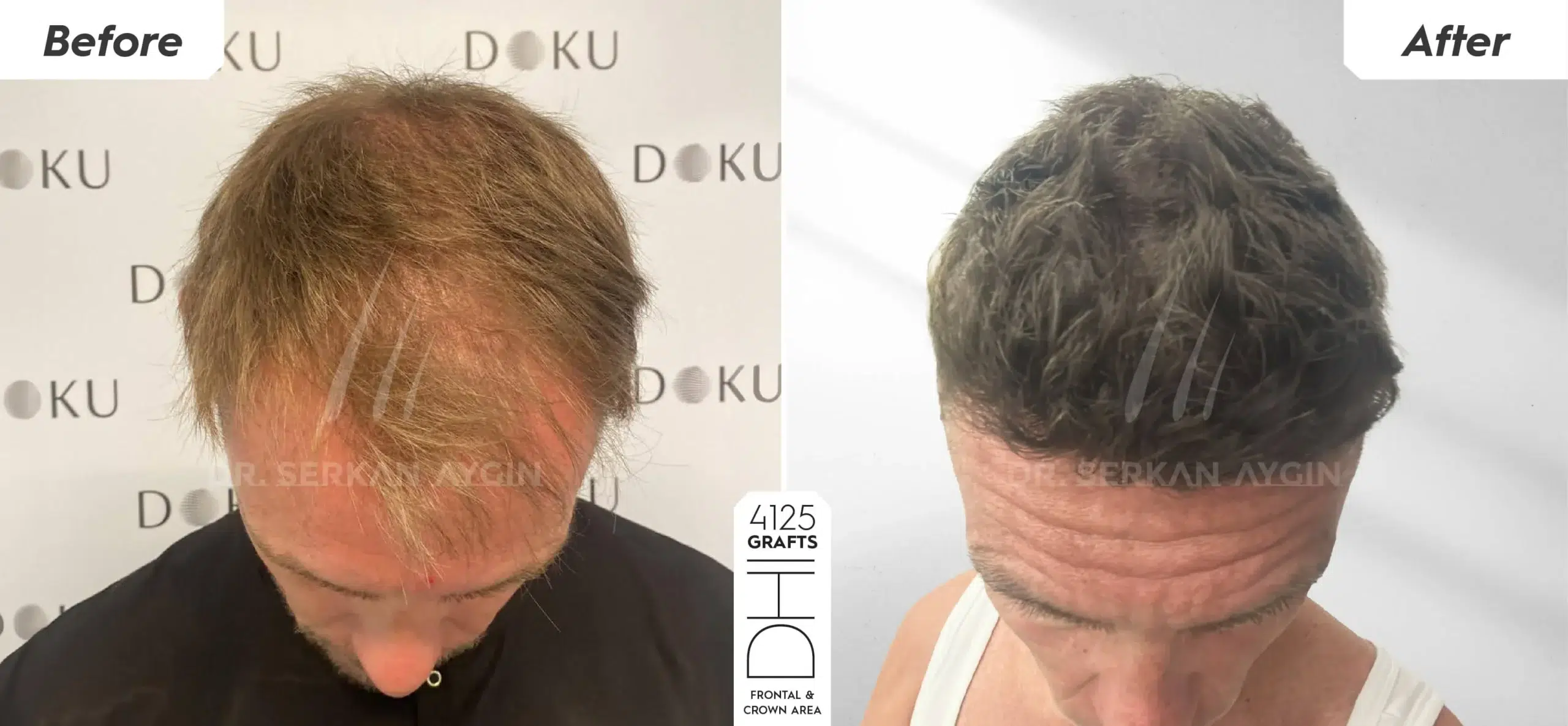 Before and after results of exosome treatment combined with hair transplant