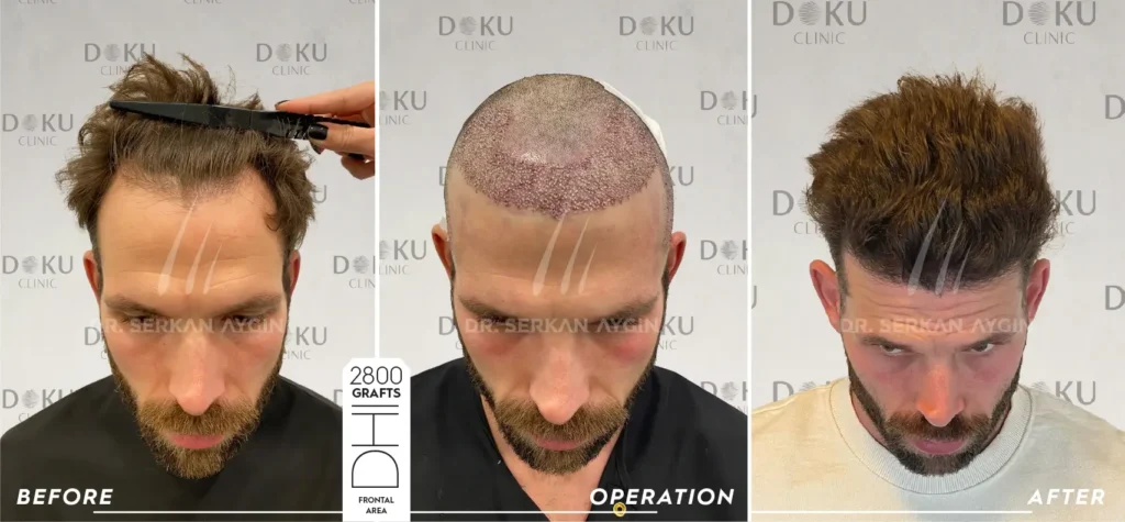 2800 before and After Gregory