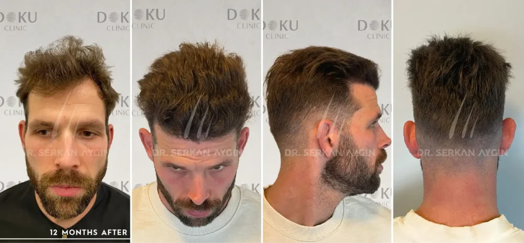 2800 before and After Gregory