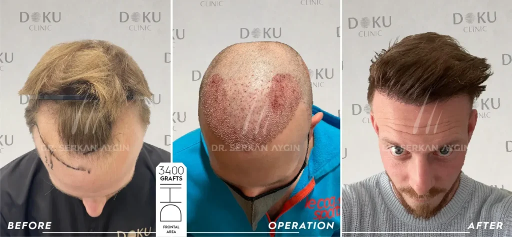 before and after Alan 3400