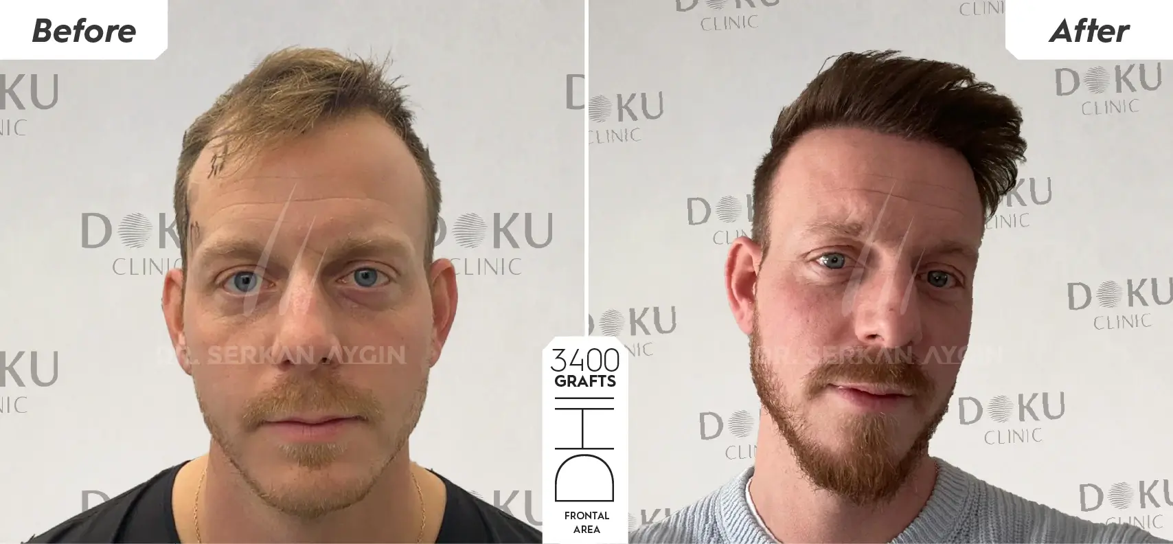 before and after ALAN 3400g