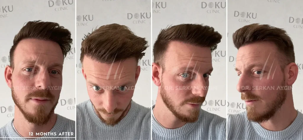 before and after Alan 3400